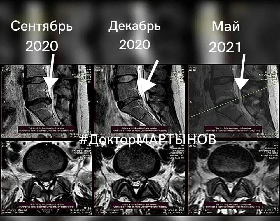 Результат резорбции грыжи на МРТ — клинический случай 6